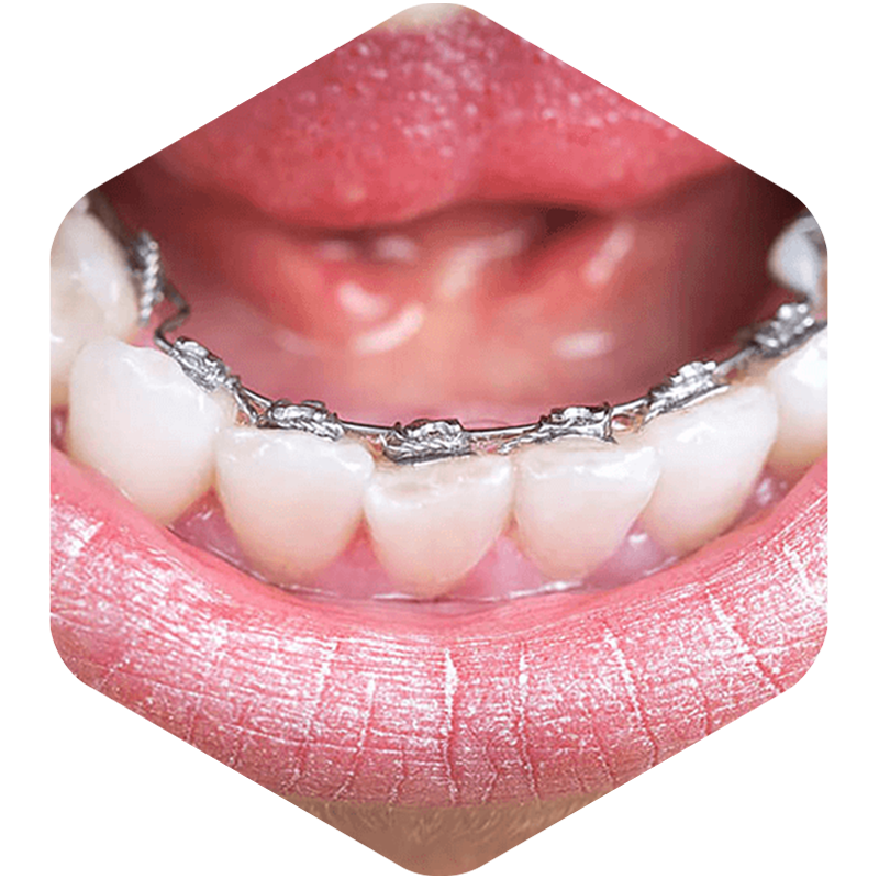 Lingual braces seen in-mouth